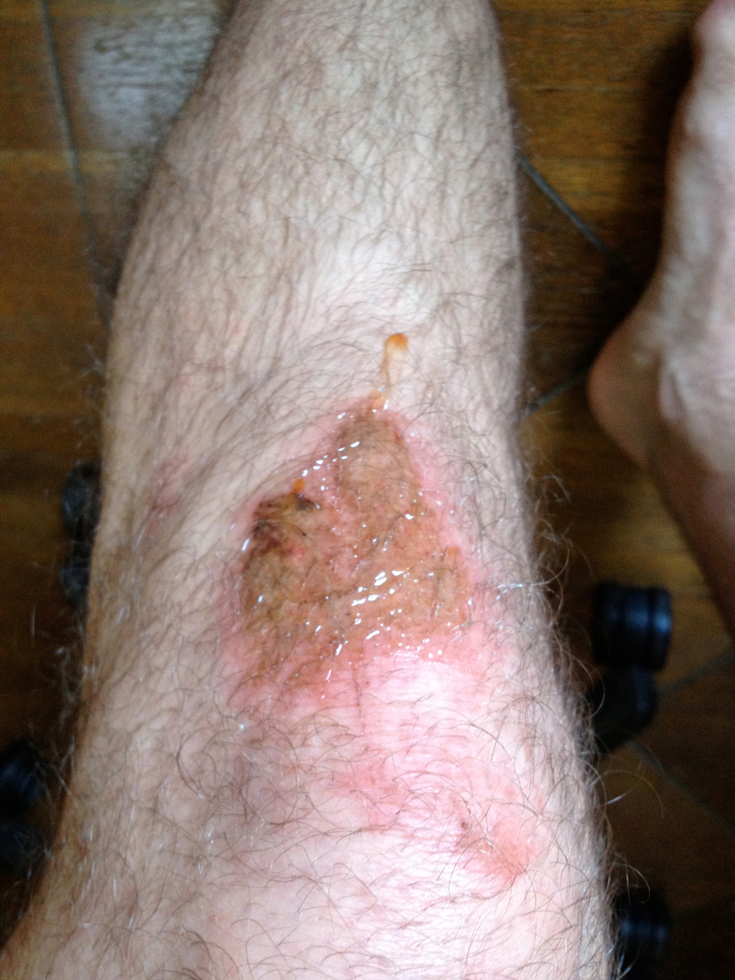 Yeesh — Slide burn. Full knee strawberry.